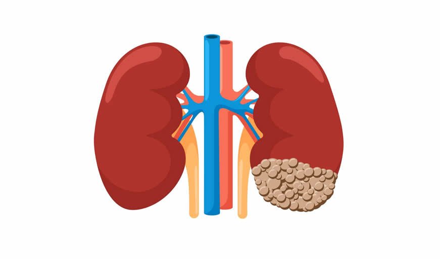 Adrenal Tumors