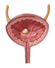 Bladder Stone