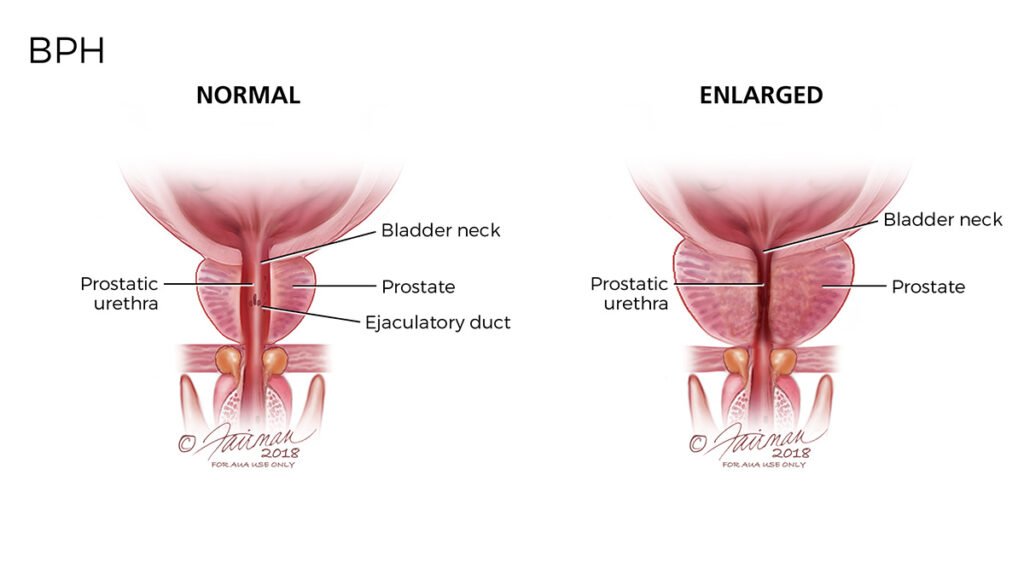 Urological Conditions