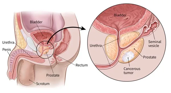 Urological Conditions