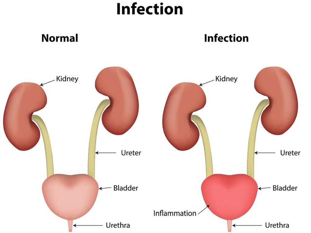 Urological Conditions